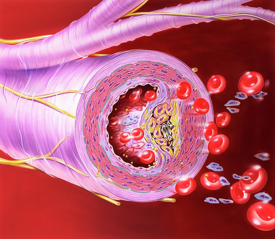 Atherosclerosis of artery photograph by john bavosi pixels