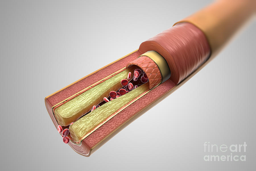Atherosclerosis Photograph by Science Picture Co
