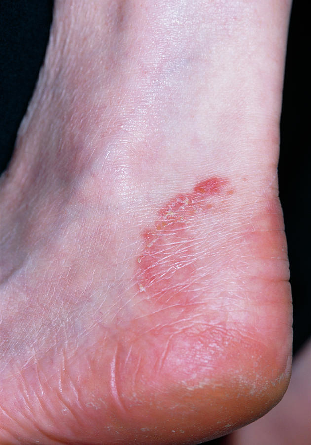 athlete-s-foot-infection-photograph-by-dr-p-marazzi-science-photo-library