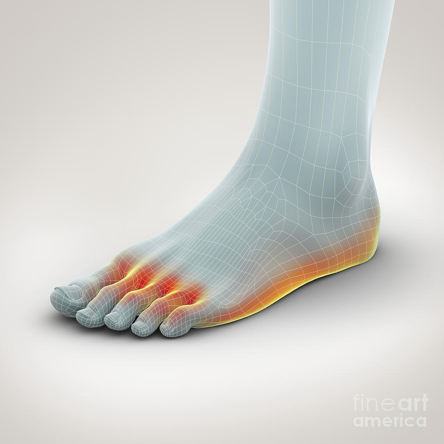 Anatomical Model Photograph - Athletes Foot by Science Picture Co