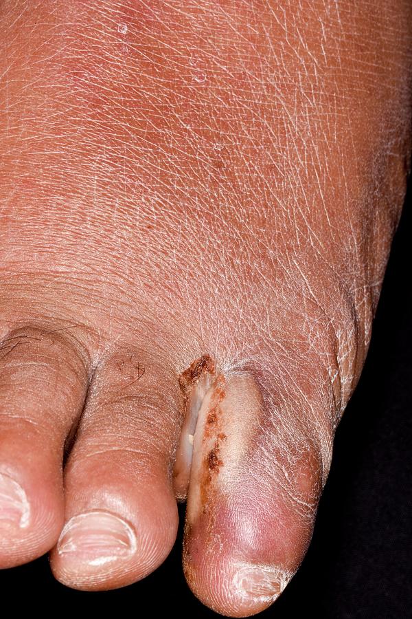 Athlete S Foot Toe Infection In Diabetes Photograph By Dr P Marazzi