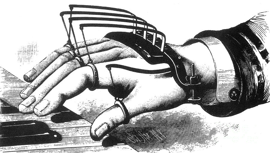 Atkins Finger-supporting Device 1881 Photograph by Science Source