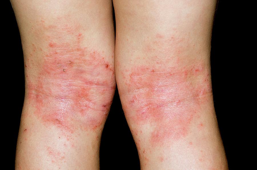 Atopic Eczema On Back Of Knees Photograph By Dr P Marazzi Science Photo Library