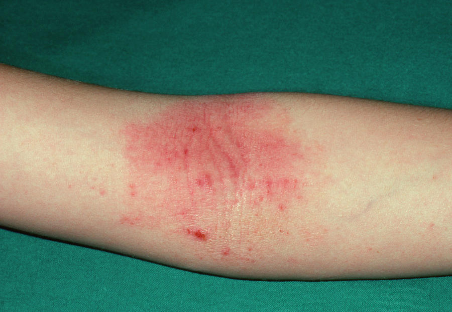 Atopic Eczema On The Inside Of The Elbow Photograph By Dr P Marazzi