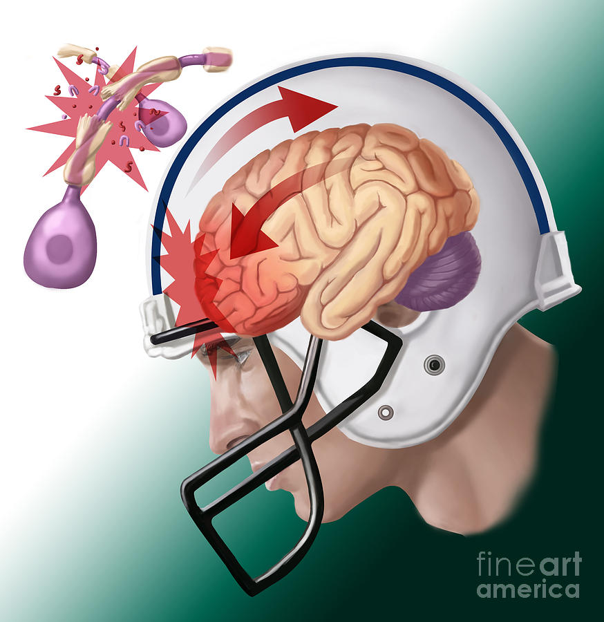 Axonal Injury From Concussion Photograph by Spencer Sutton