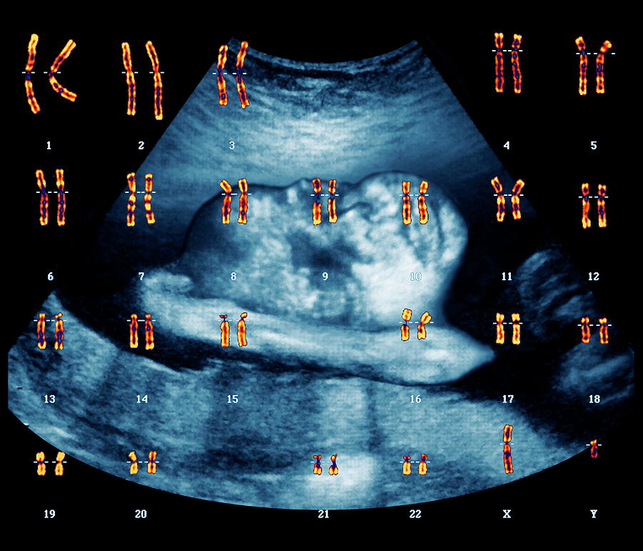 Baby Gender Determination Photograph by Zephyr/science Photo Library