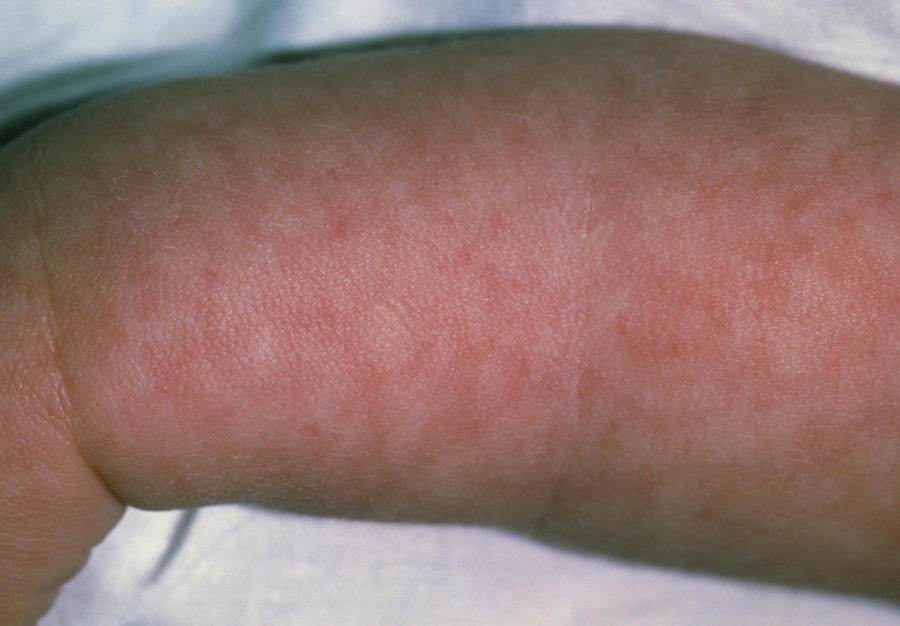 Baby Girl's Arm Showing Rash From Viral Meningitis Photograph by Dr P