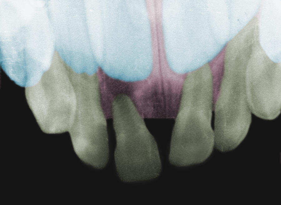 Baby Teeth Behind Adult Teeth, X-ray Photograph by Science Stock Photography