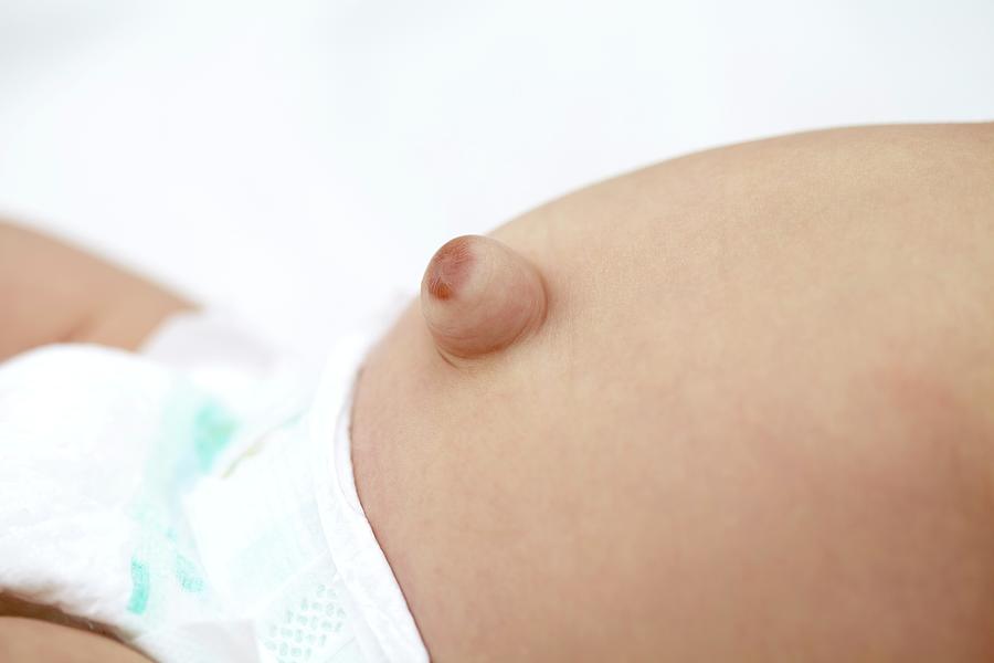 People Photograph - Baby With Umbilical Hernia by Ruth Jenkinson