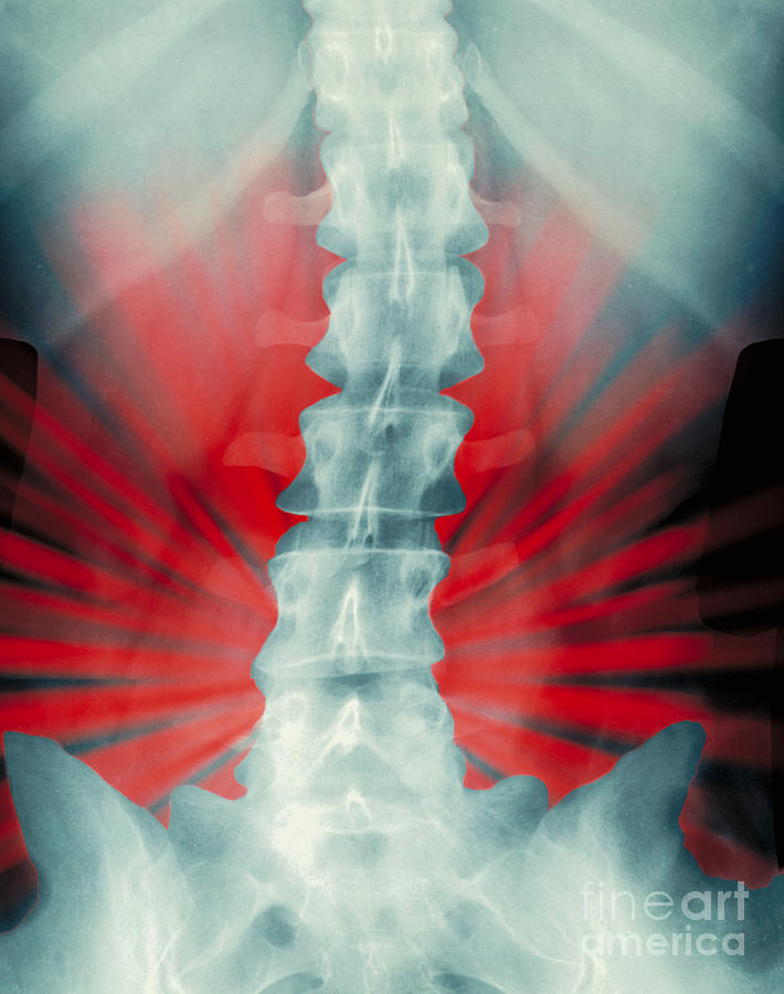 Back Pain Photograph by Erich Schrempp