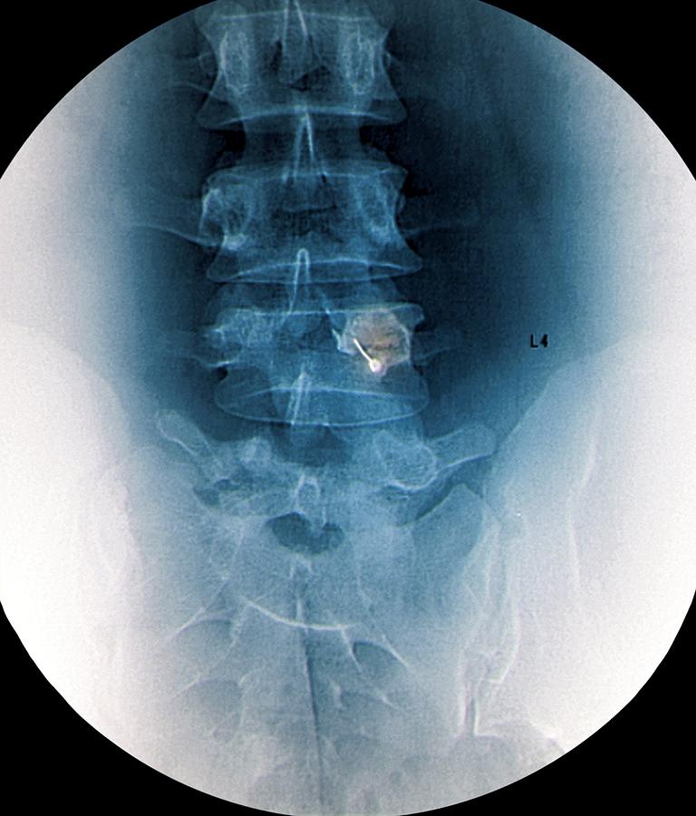 Device Photograph - Back pain treatment, X-ray by Science Photo Library