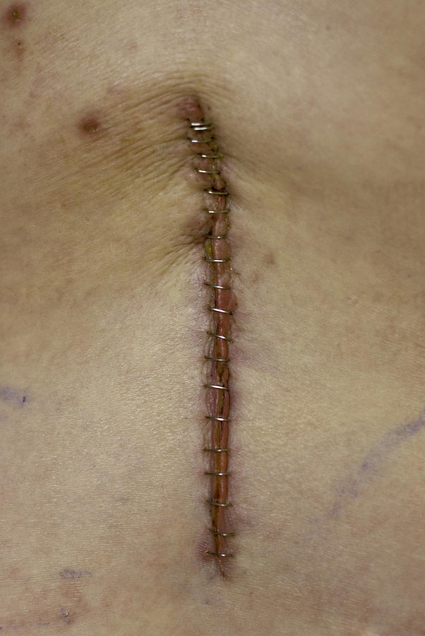 Back Surgery Photograph by Westhoff