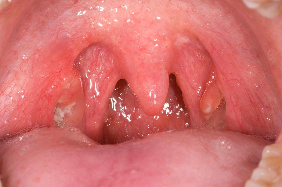 Bacterial Tonsillitis Photograph By Dr P Marazzi Science Photo Library My XXX Hot Girl