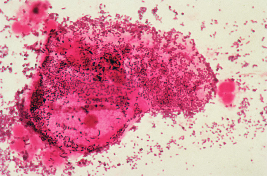 bacterial vaginosis cytology