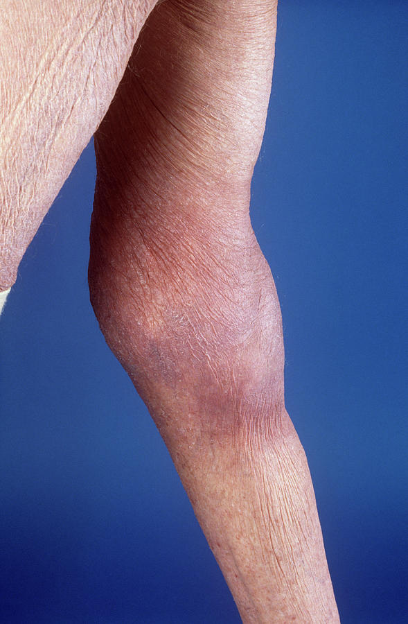 Baker's Cyst by Mike Devlin/science Photo Library