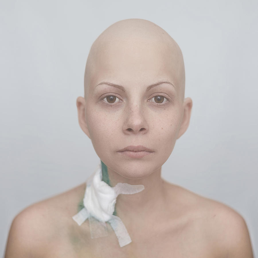 Bald Caucasian cancer patient with bandage on neck Photograph by Vladimir Serov