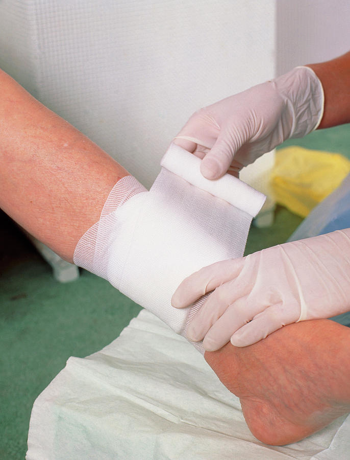 Bandage Photograph - Bandages Being Applied To Leg Ulcer by Chris Priest/science Photo Library