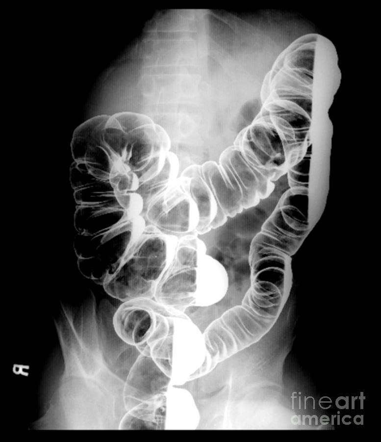 Barium Enema X-ray Photograph by Living Art Enterprises, LLC