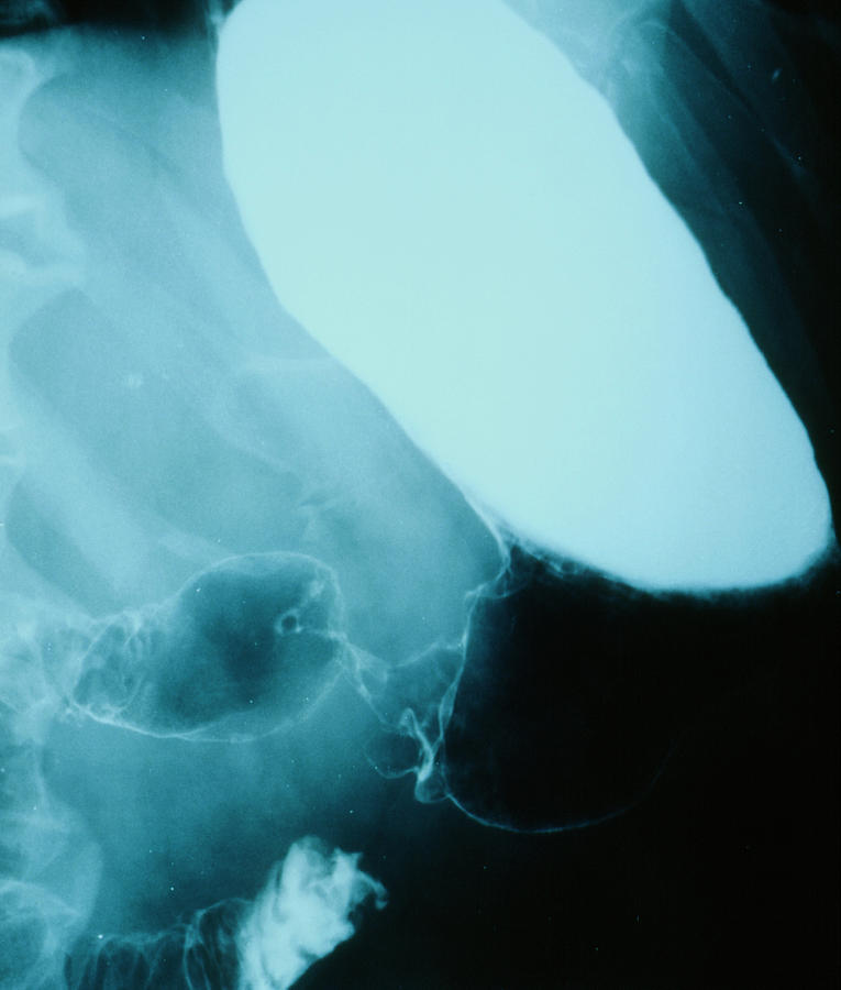 Barium Meal Xray Of Cancer Photograph by Science Photo Library Pixels