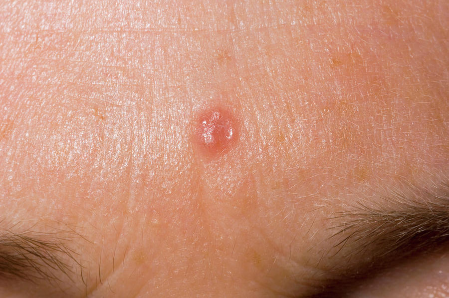 Basal Cell Carcinoma Dr P Marazziscience Photo Library 