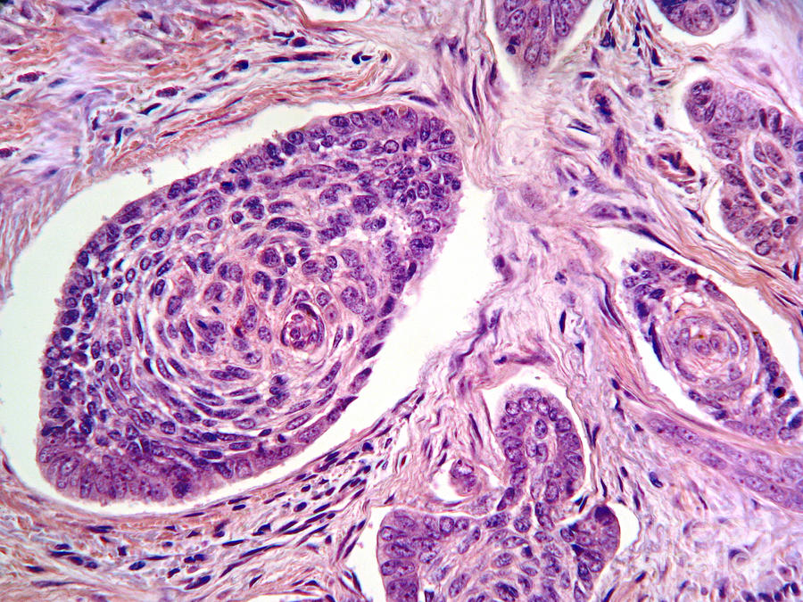 Basal Cell Carcinoma Photograph by Garry DeLong