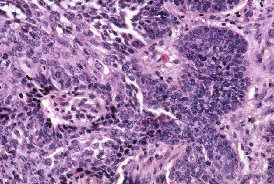 Basal-cell Carcinoma, Lm Photograph by Michael Abbey