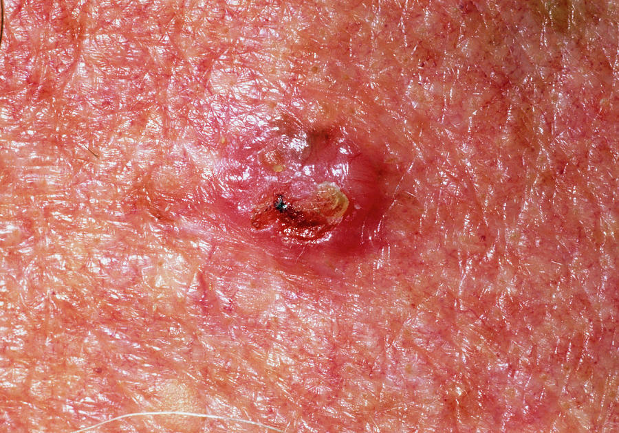 Basal Cell Carcinoma On A 78 Year Old Mans Skin Photograph By Dr P