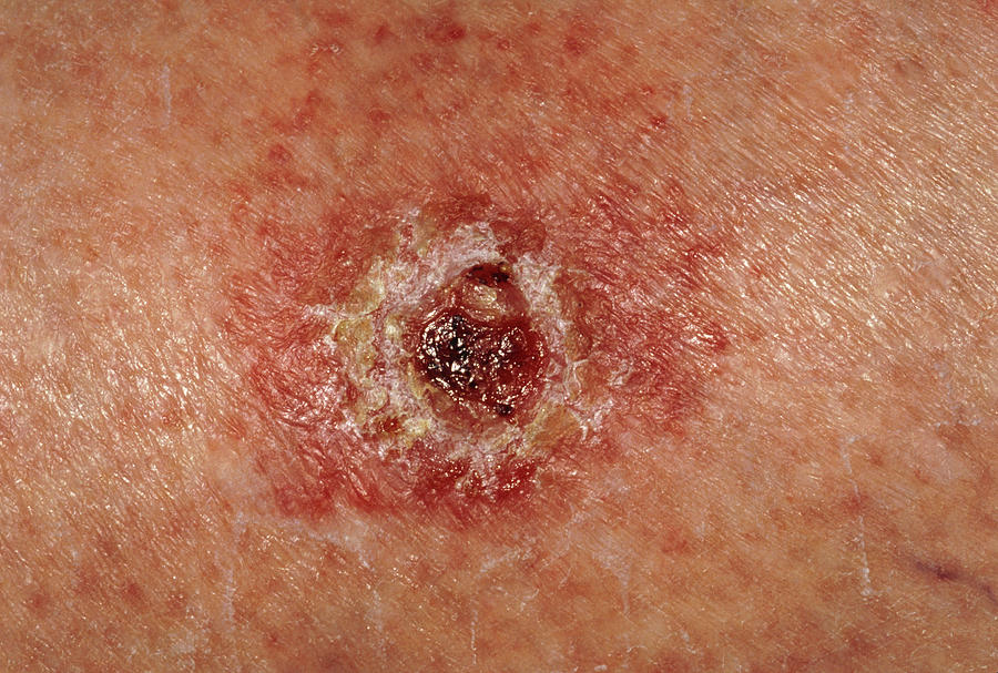 Basal Cell Carcinoma On Leg Of Elderly Woman Photograph by Dr P ...