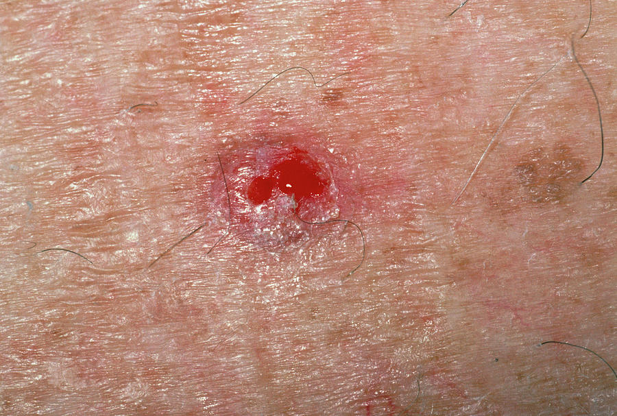 Basal Cell Carcinoma On Skin On The Back Photograph By Dr P Marazzi