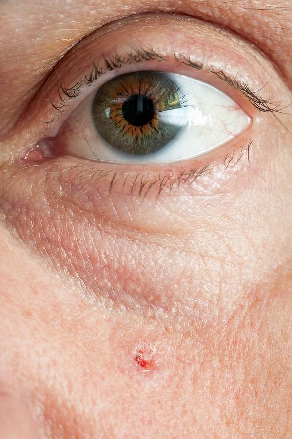 Basal Cell Carcinoma Photograph By Saturn Stillsscience Photo Library