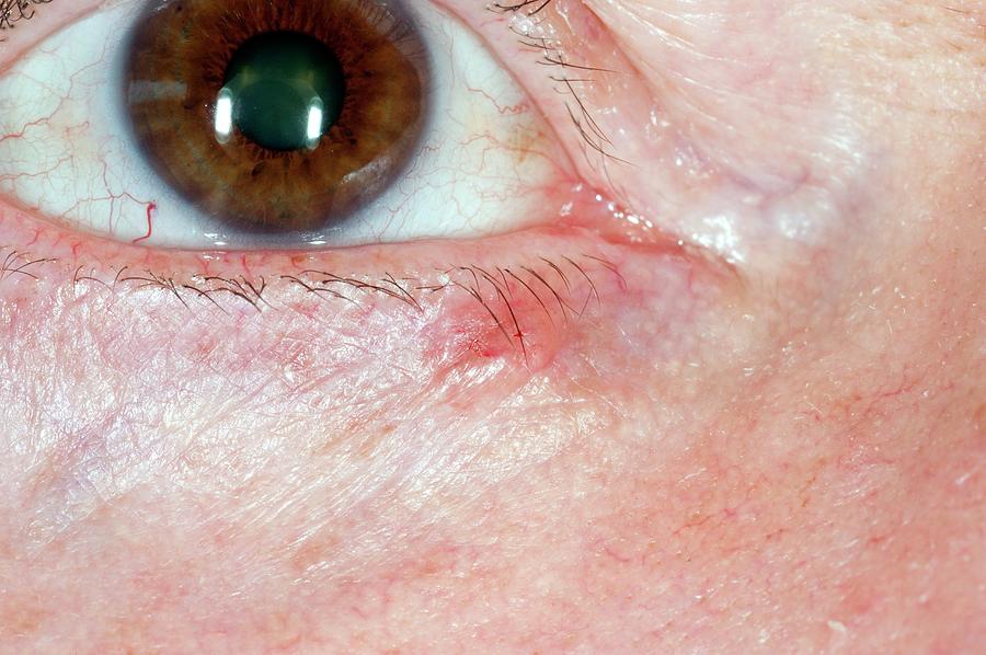 Basal Cell Skin Cancer On Eyelid Photograph By Dr P Marazziscience Photo Library 