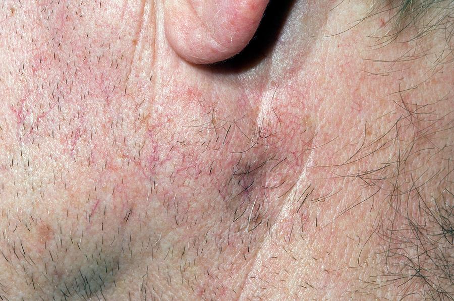 Basal Cell Skin Cancer Spread To Lymph Photograph by Dr P. Marazzi