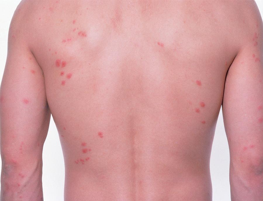 bed-bug-bites-on-person-s-back-photograph-by-science-photo-library