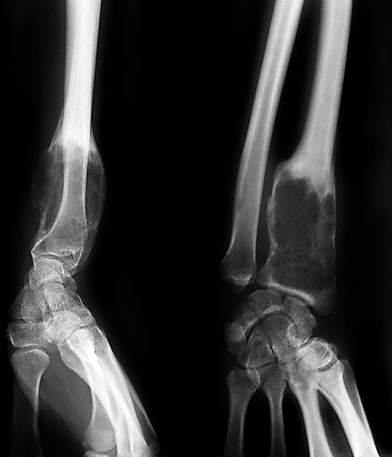 Benign Bone Tumour Photograph by Zephyr/science Photo Library - Fine ...