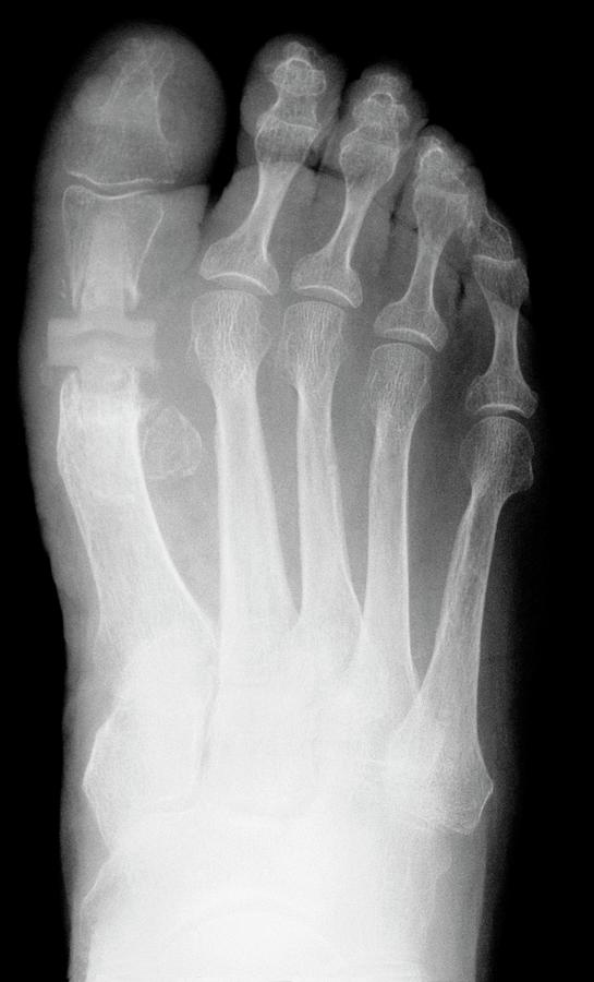 Big Toe Joint Replacement Photograph by Mike Devlin/science Photo Library