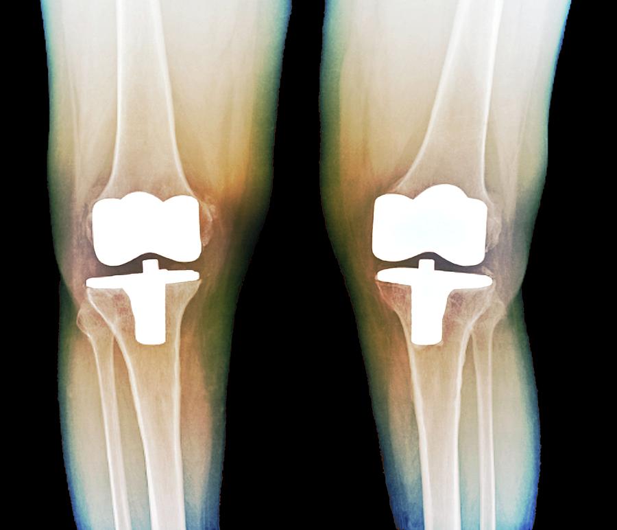 Bilateral Total Knee Replacement Photograph By Zephyr/science Photo ...