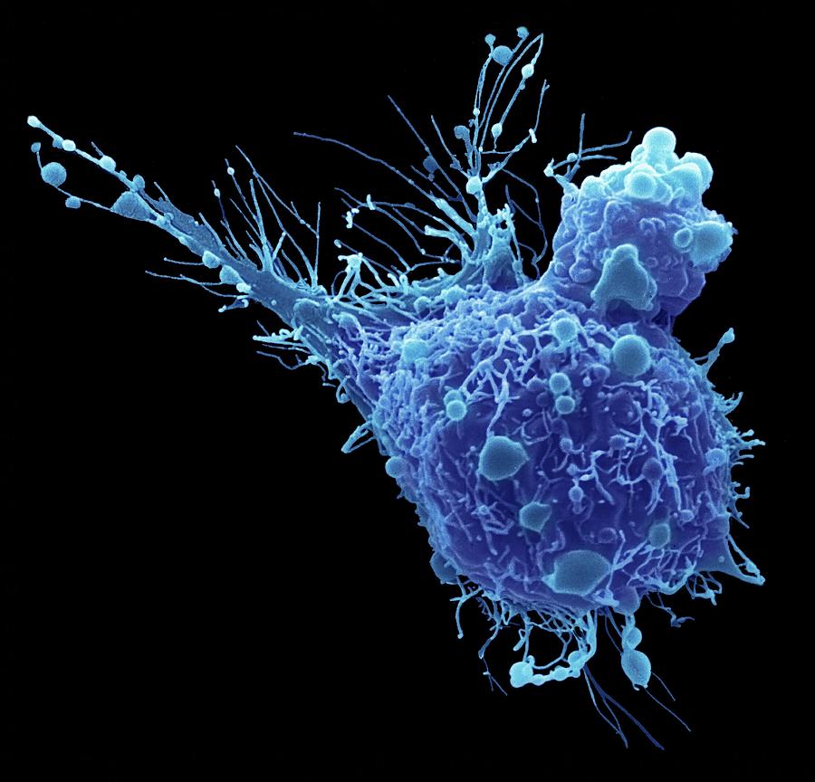 bladder-cancer-cell-photograph-by-steve-gschmeissner-science-photo