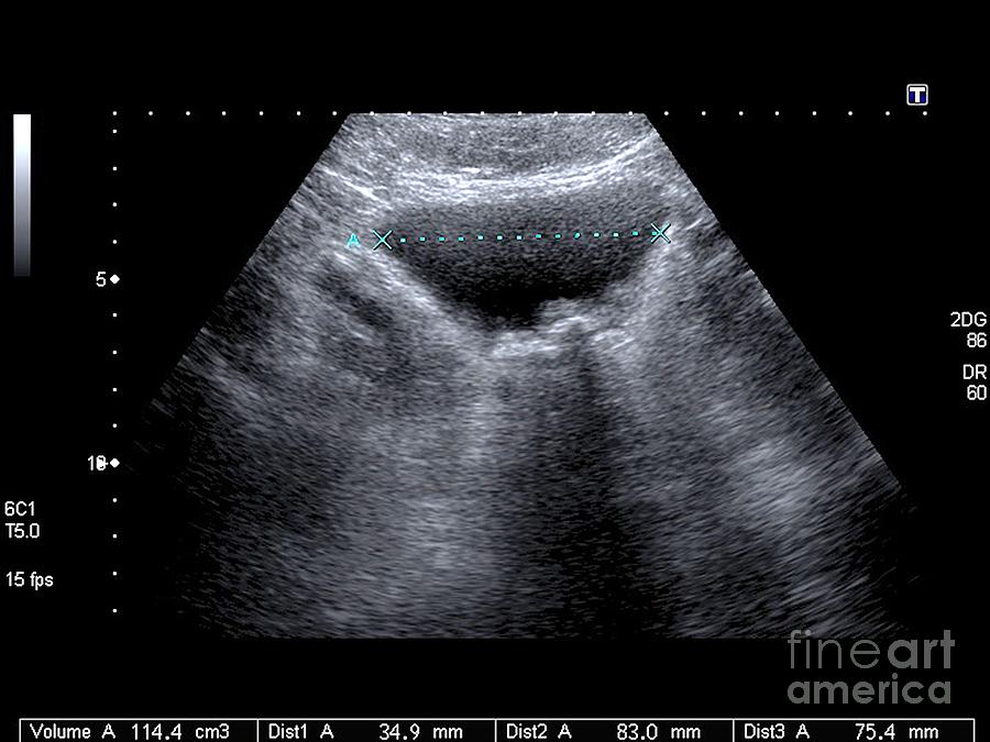 Bladder Stones, Ultrasound Scan By Science Photo Library