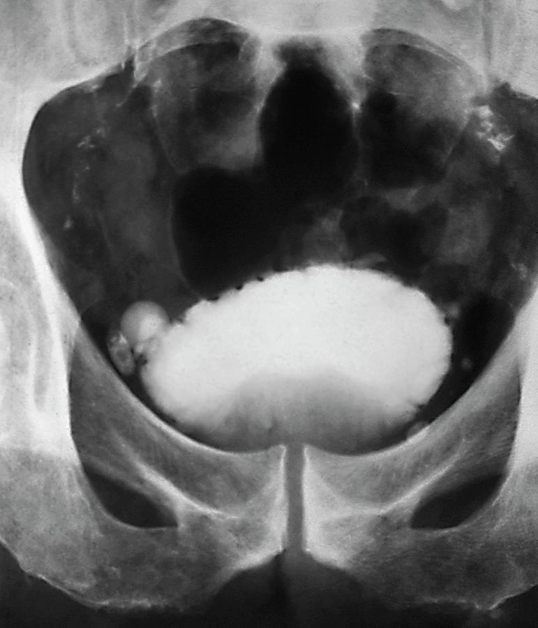 Urogram Photograph - Bladder Test For Prostate Cancer (2 Of 2) by Zephyr/science Photo Library