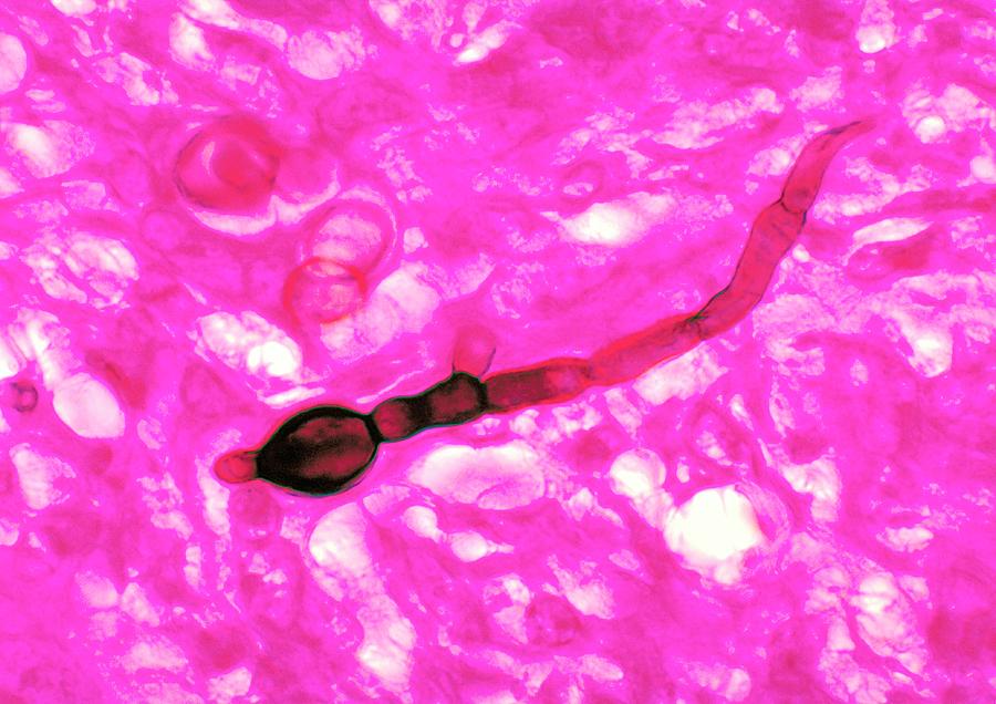 Abnormal Photograph - Blastomycosis by Cdc/science Photo Library