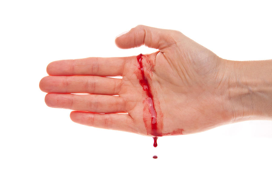 Bleeding hand with a real cut Photograph by Kerstin Klaassen