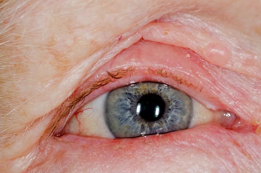 Blepharitis And Eyelid Eczema Photograph By Dr P Marazziscience Photo Library 5608