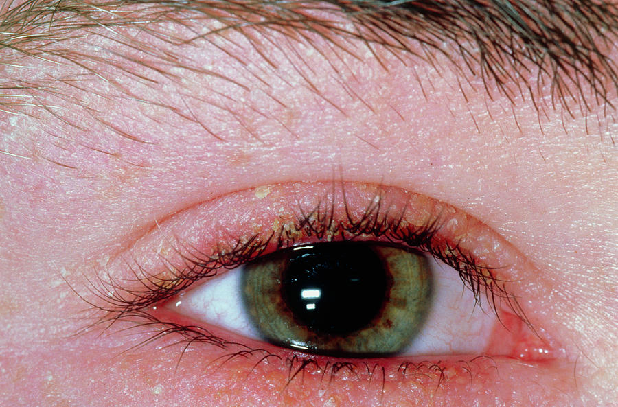 Blepharitis: Infection At Base Of Eyelashes Photograph by Dr P. Marazzi ...