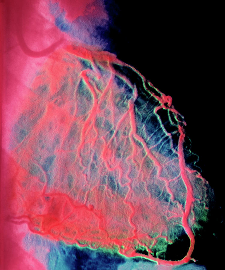 Blocked Heart Artery Photograph by Alain Pol, Ism/science Photo Library
