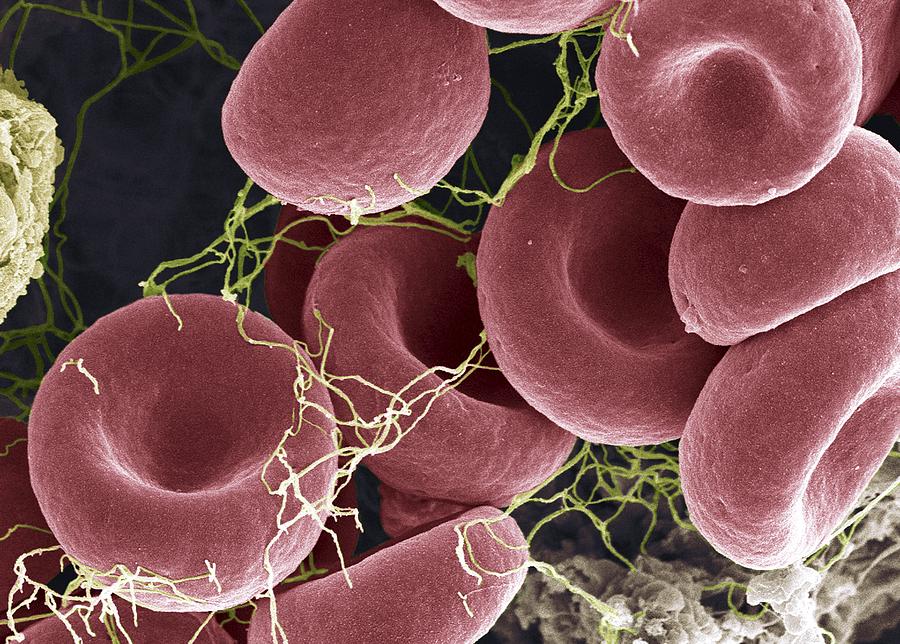 Blood clot, colored scanning electron micrograph (SEM) Photograph by Science Photo Library - STEVE GSCHMEISSNER.