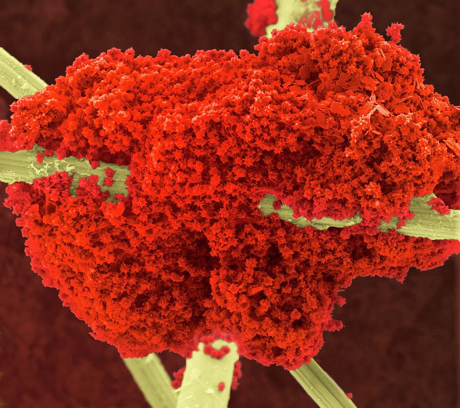Blood Clot On Gauze Photograph by Science Photo Library