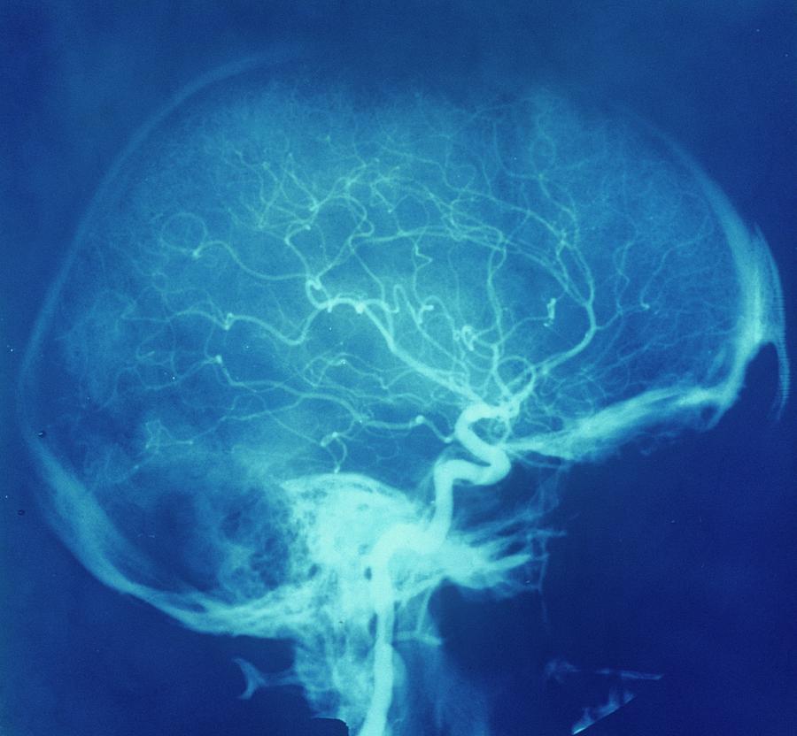 Anatomical Photograph - Blood Supply To The Head by Alain Pol - Cnri Anatomical Photograph - Blood Supply To The Head by Alain Pol - Cnri