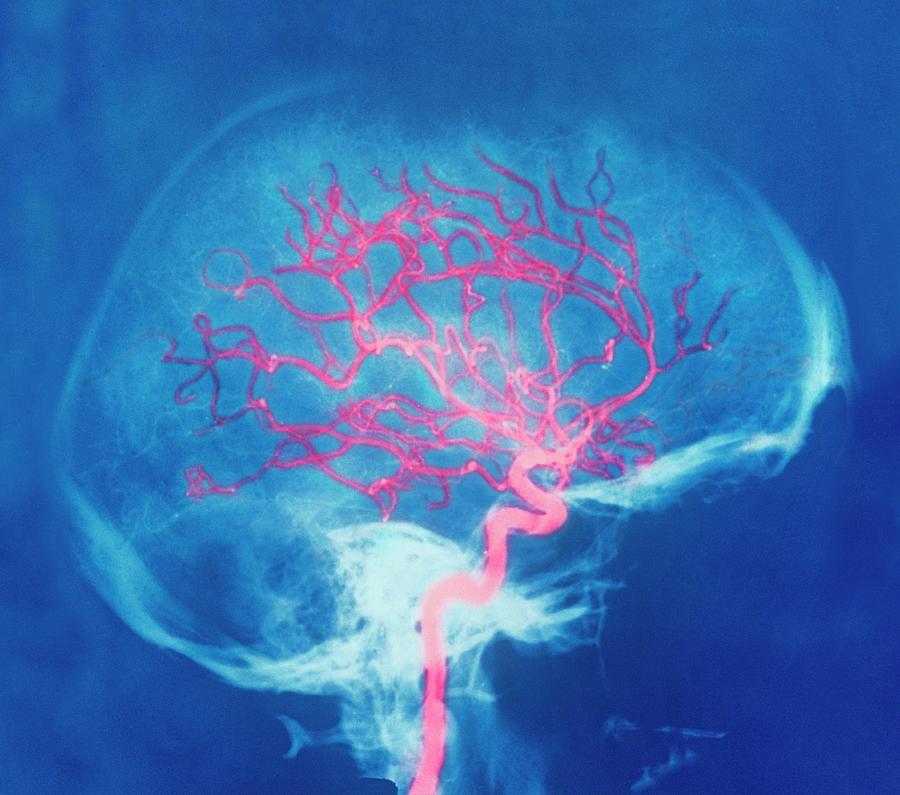 Blood Supply To The Head Photograph by Cnri/science Photo Library