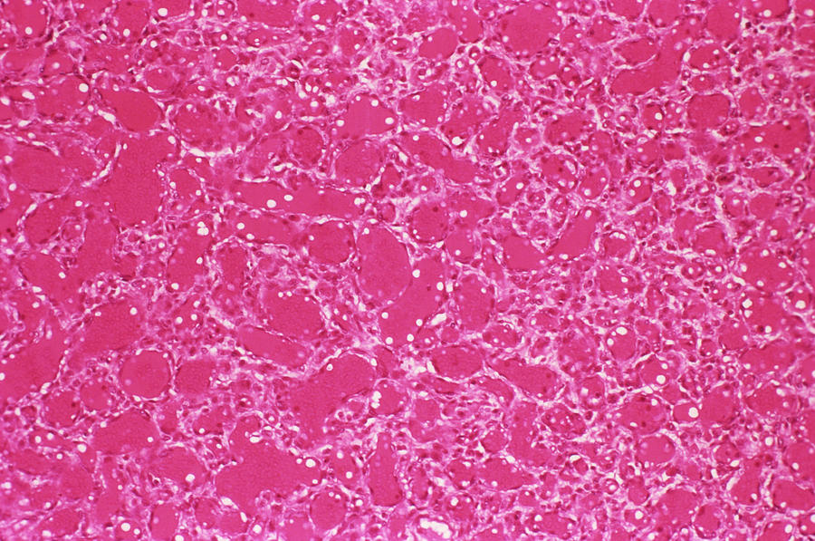 Blood Vessel Tumour Photograph by Cnri/science Photo Library