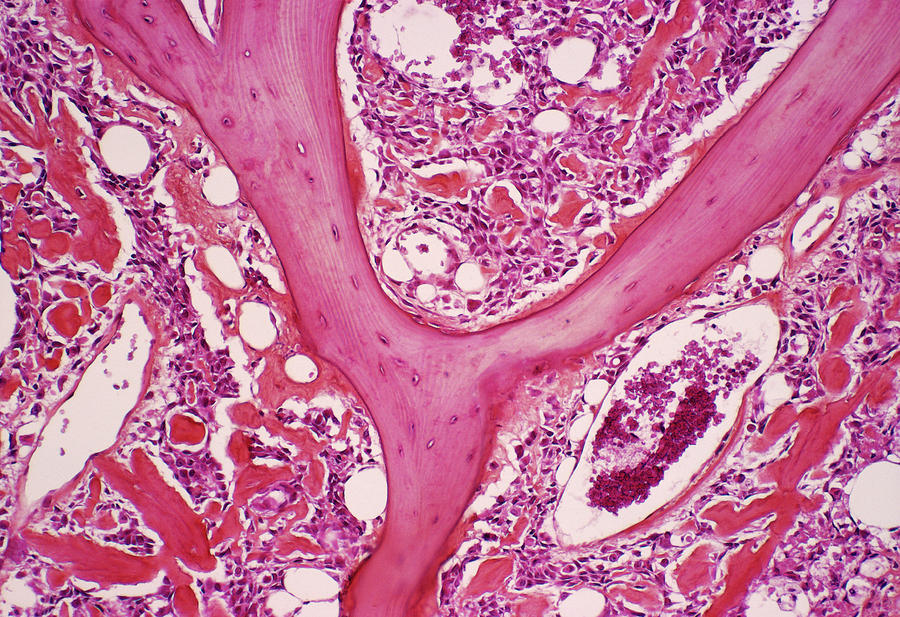 Bone Cancer Photograph by Cnri/science Photo Library